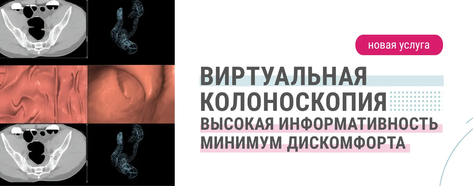 КТ-колоноскопия КТ-колоноскопия